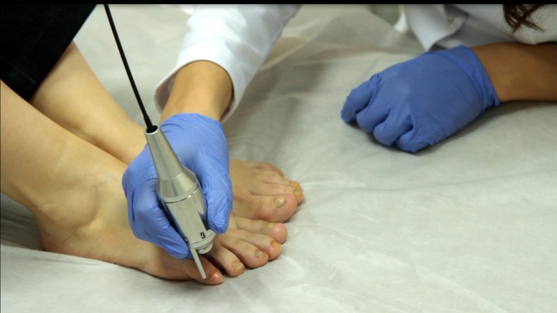 Лечение грибка ногтя запущенной формы лазером