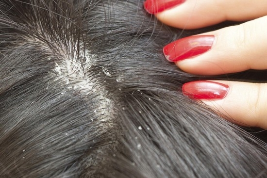 Лечение себорейного дерматита волосистой части головы 