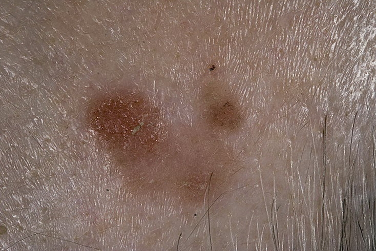 Кератоз кожи: лечение