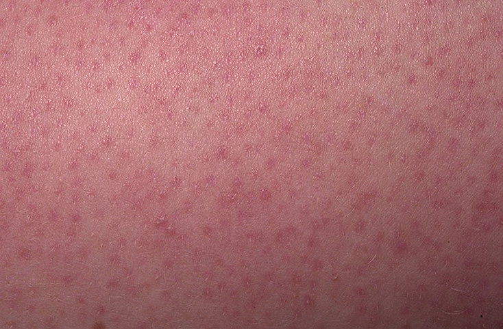 Кератоз кожи. Симптомы, лечение и возможные последствия кератоза