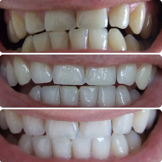 Плюсы и минусы отбеливания зубов с помощью полосок
