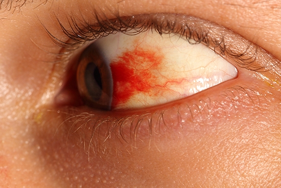 Принимать какие-либо серьезные меры при появлении кровоподтеков на глазном яблоке не стоит