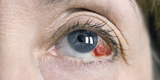  Казалось бы, чем может быть страшно кровоизлияние в сетчатку глаза?