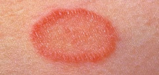 Виды грибковых заболеваний кожи и симптоматика