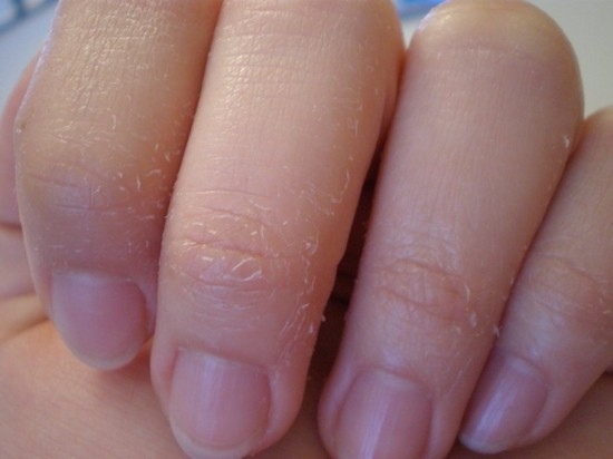 Шелушение кожи на пальцах