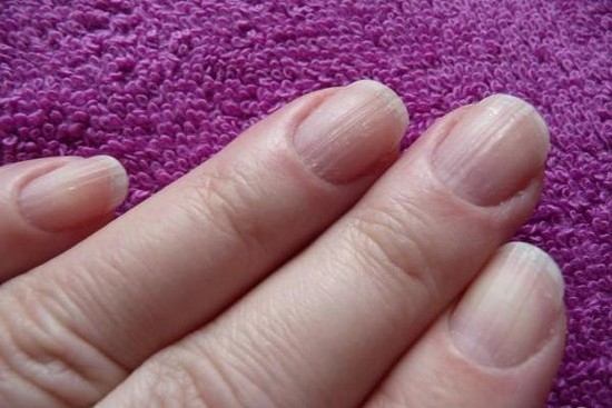 Причины поперечных полос на ногтях рук