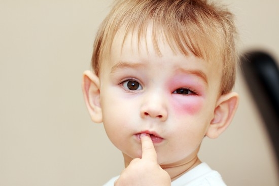 как проявляется вирусный конъюнктивит у детей
