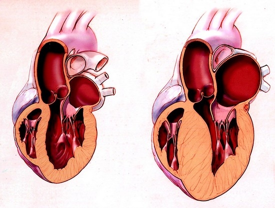 Причины и симптомы гипертрофии левого желудочка сердца