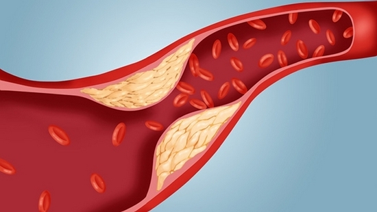 Как понизить холестерин в крови?