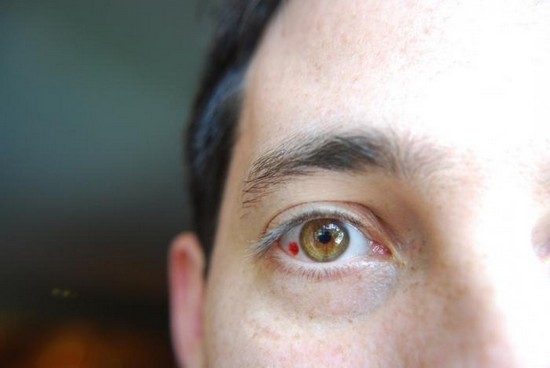 Почему лопаются капилляры в глазах: причины