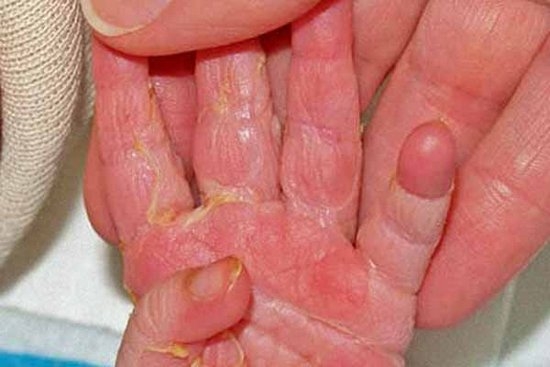 Облезание кожи как сигнал опасности: когда ребенку требуется лечение