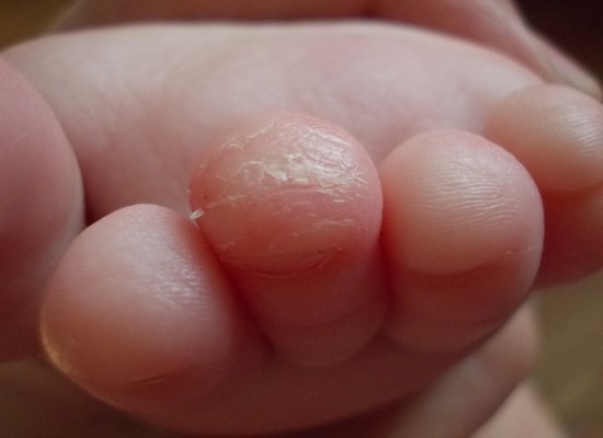О самых безобидных причинах шелушения кожи на руках и ногах ребенка