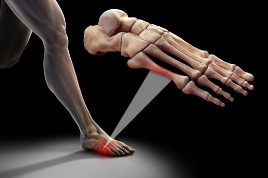 Как распознать перелом мизинца на ноге