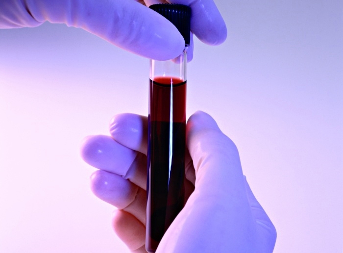 Что делать, если билирубин в крови повышен?