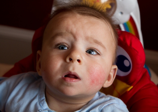 Почему у ребенка красные щеки?