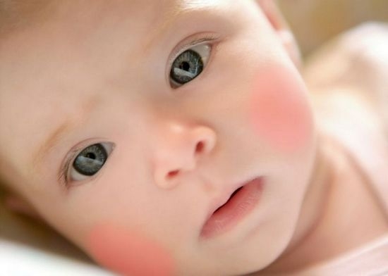 Красные щеки у ребенка: причины