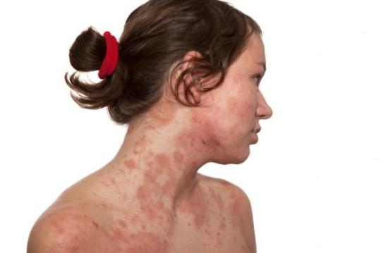 Холодовая аллергия на лице: симптомы
