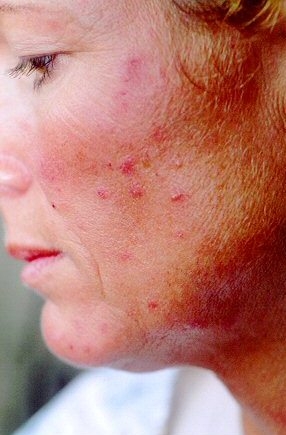 Подкожный клещ на лице: лечение, фото