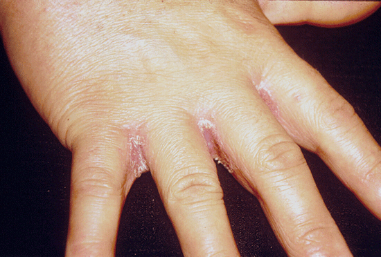 Трещинки и гнойные высыпания между пальцев