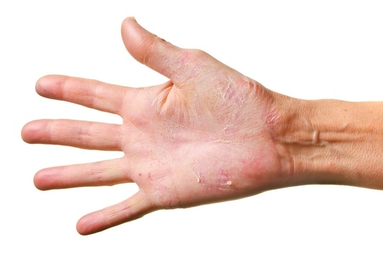 Грибок на руках: симптомы
