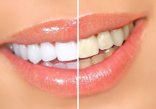 Отбеливание зубов перекисью водорода: отзывы 