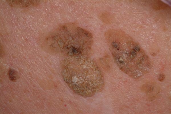 Кератоз кожи. Симптомы, лечение и возможные последствия кератоза