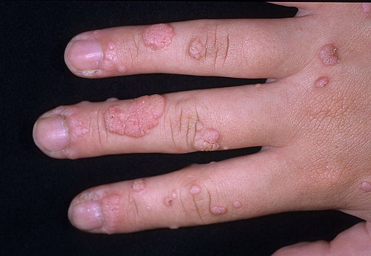Бородавка на пальце руки: фото