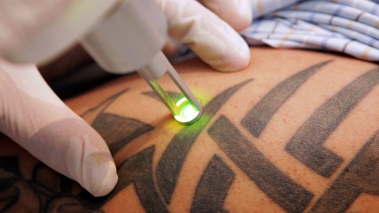Удаление татуировки: средства и методы