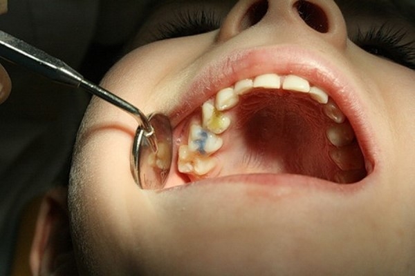 Сколько молочных зубов должно быть у детей?
