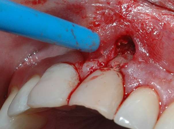Киста зуба: симптомы