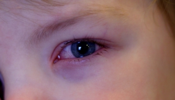 Красные глаза у ребенка: причины и лечение