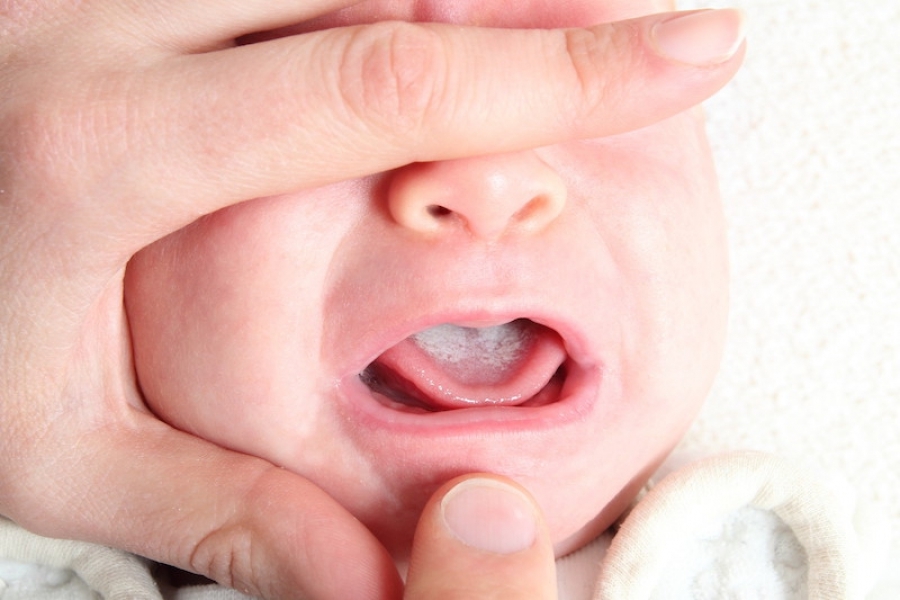Кроме того, замечено, что наиболее подвержены молочнице дети, рожденные раньше срока