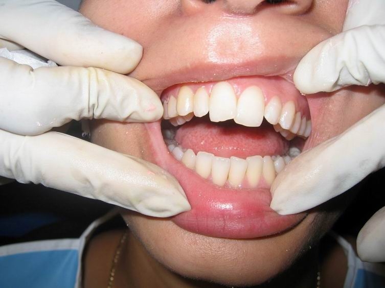 Сам себе стоматолог, или Чем заканчиваются эксперименты по выравниванию зубов?