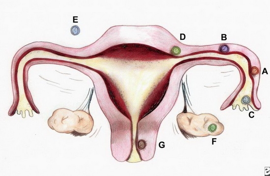 Возможные патологии желтого тела при беременности