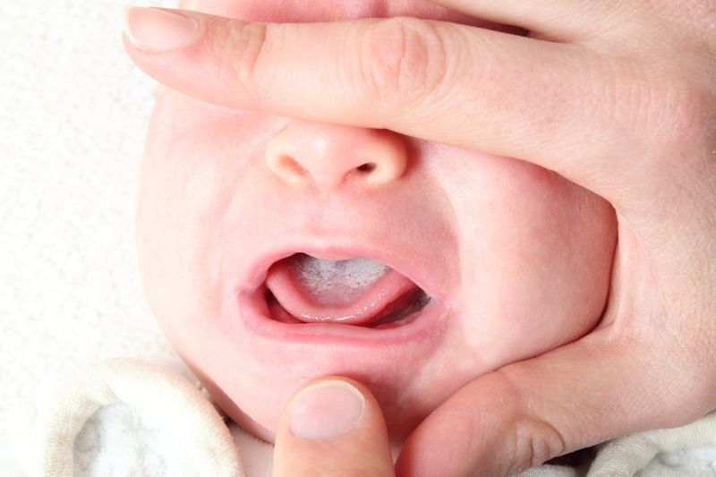 Признаки молочницы можно наблюдать у младенца уже через несколько суток после родов