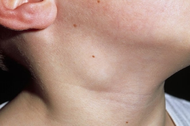 Воспаление лимфоузлов на шее у мужчин фото