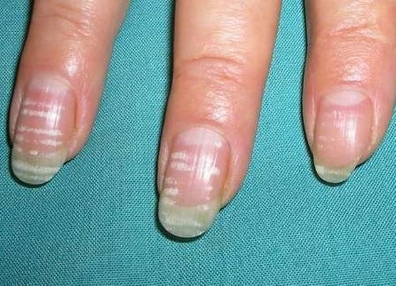Белые пятна на ногтях известны под названием «лейконихия»