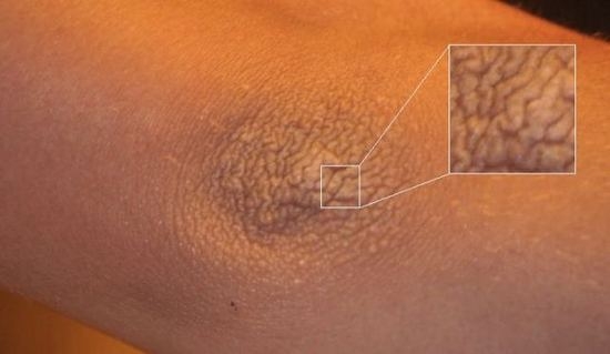 Сухая и шершавая кожа на локтях: причина и лечение